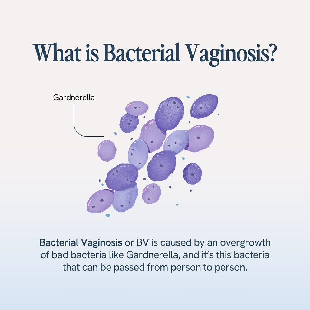 Infographic explaining Bacterial Vaginosis (BV) as an overgrowth of bad bacteria like Gardnerella, which can be transmitted between individuals.