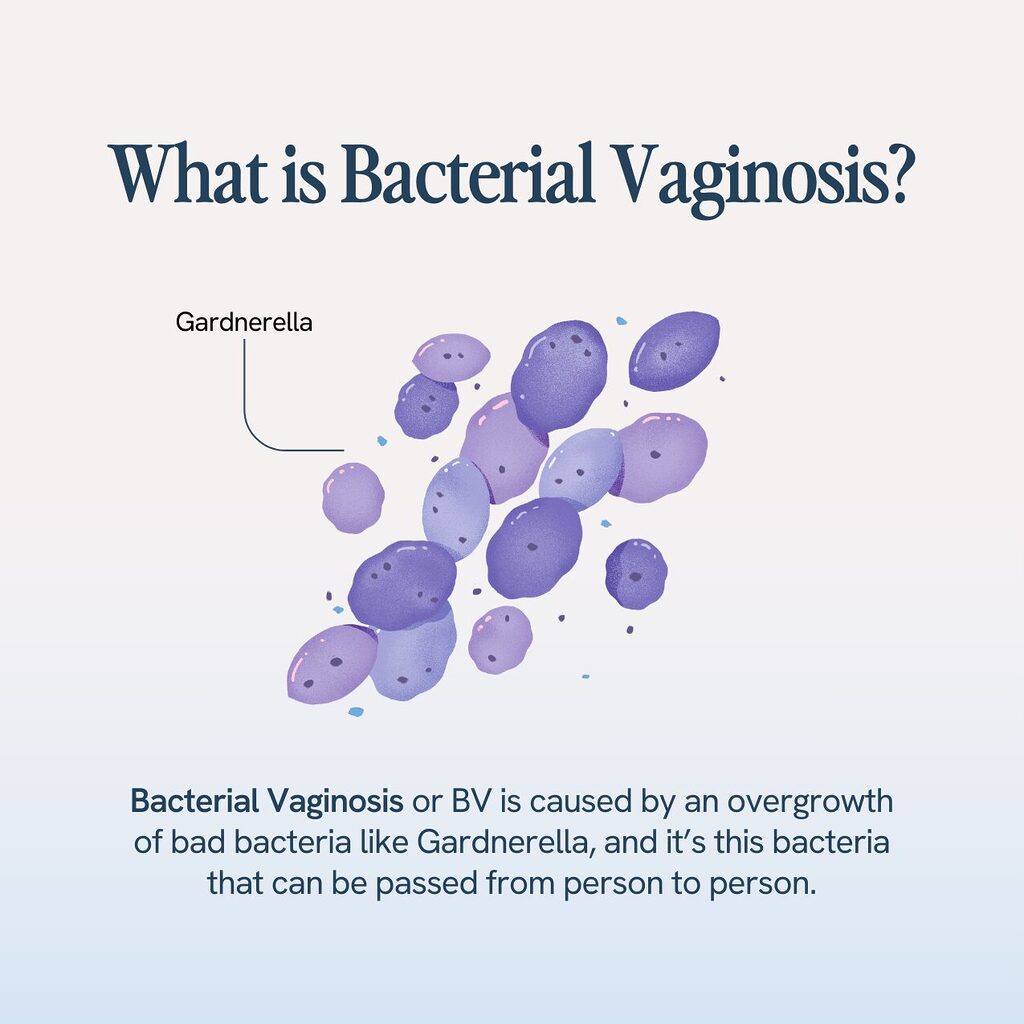 informative graphic about Bacterial Vaginosis (BV), highlighting that it's caused by an overgrowth of bacteria such as Gardnerella, which can be transmitted between individuals. The graphic includes a visualization of the bacteria.






