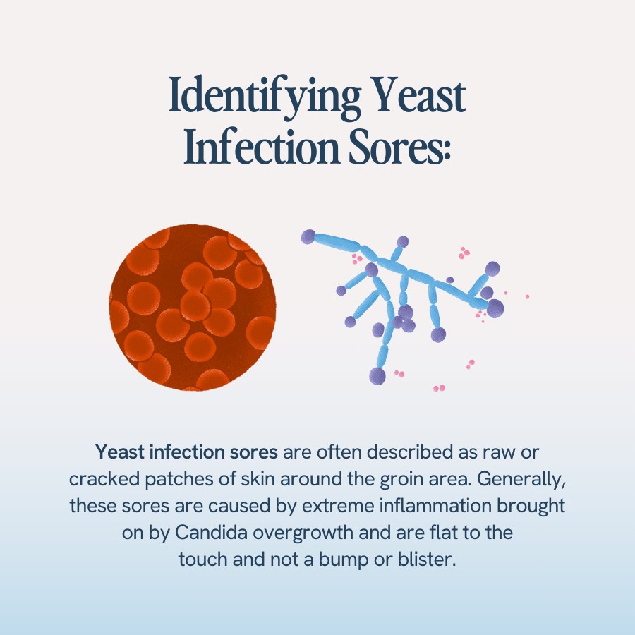 “Text explaining that yeast infection sores are raw or cracked patches of skin around the groin caused by extreme inflammation from Candida overgrowth, and are flat to the touch, not a bump or blister. Illustrations include microscopic views of Candida fungi.”