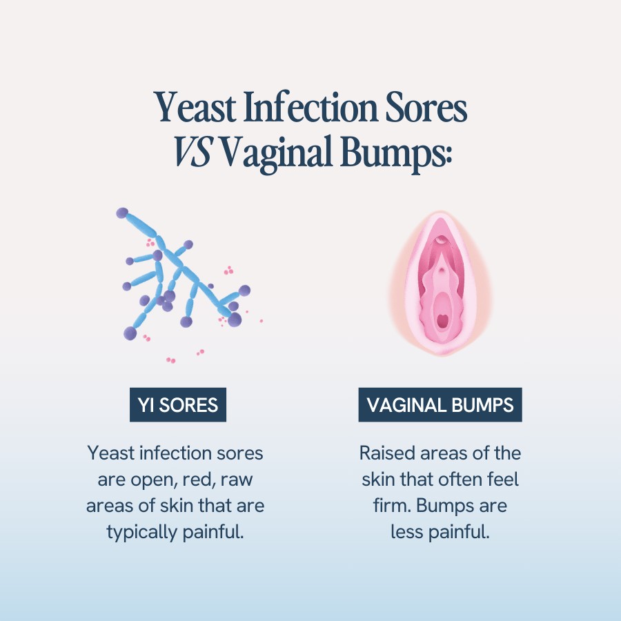 “Text comparing yeast infection sores and vaginal bumps: yeast infection sores are open, red, raw areas of skin that are typically painful, while vaginal bumps are raised, firm areas of skin that are less painful. Illustrations include a microscopic view of Candida fungi and a diagram of the vaginal area.”