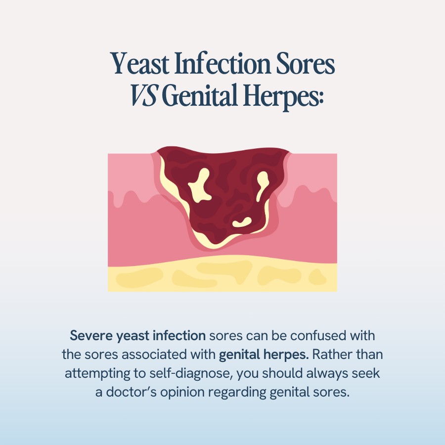 “Text explaining that severe yeast infection sores can be confused with genital herpes sores and advising to seek a doctor’s opinion rather than self-diagnosing. Illustration includes a depiction of a genital sore.”